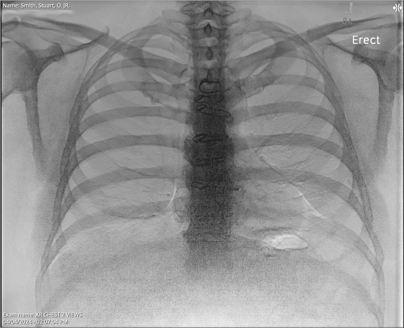 2024 Odyssey from Pain to Recovery - April 4, 2024, chest x-ray of Stuart O. Smith, Jr. 2024 Odyssey from Pain to Recovery - April 4, 2024, chest x-ray of Stuart O. Smith, Jr.