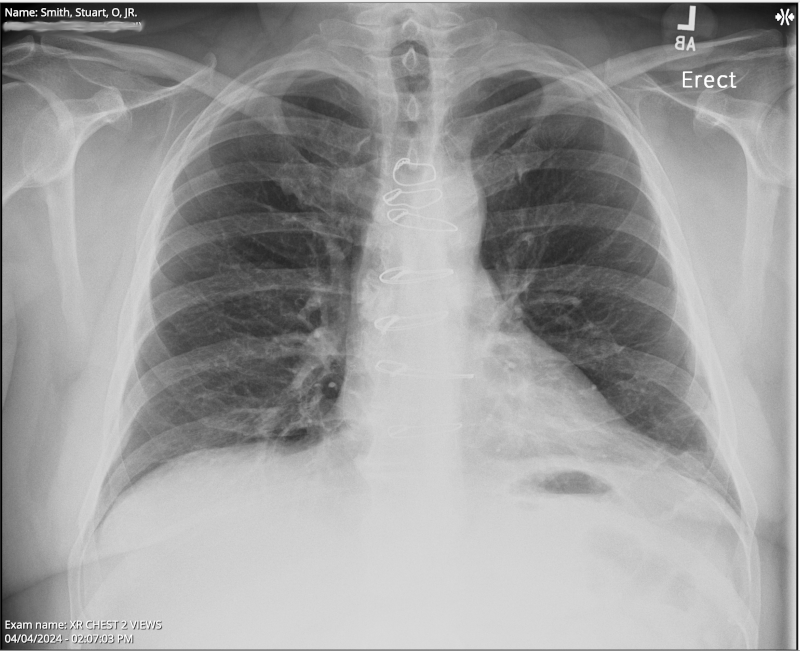 April 4, 2024 - If you look closely at this X-ray, you will see rings which are the median sternotomy wires. April 4, 2024 - If you look closely at this X-ray, you will see rings which are the median sternotomy wires.