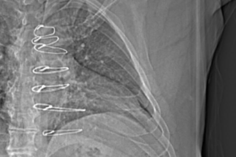 June 6, 2024 - CAT Scan shows the sternal wires that are in my chest. June 6, 2024 - CAT Scan shows the sternal wires that are in my chest.