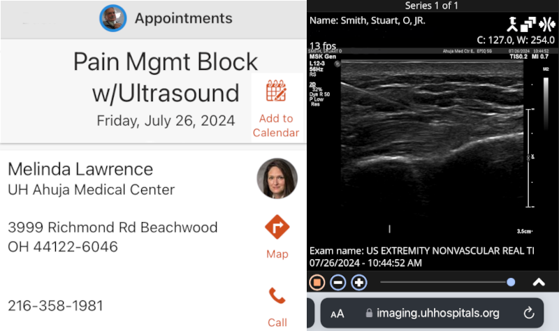 JJuly 26, 2024 - bilateral sternocostal joint injection under ultrasound guidance performed by Dr. Melinda Lawrence. July 26, 2024 - bilateral sternocostal joint injection under ultrasound guidance performed by Dr. Melinda Lawrence.