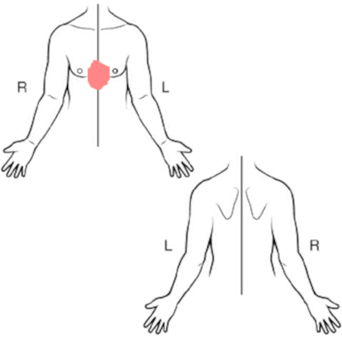 August 14, 2024 - Dr. Harpreet Singh's progress notes -- image of chest pain's location.' August 14, 2024 - Dr. Harpreet Singh's progress notes -- image of chest pain's location.