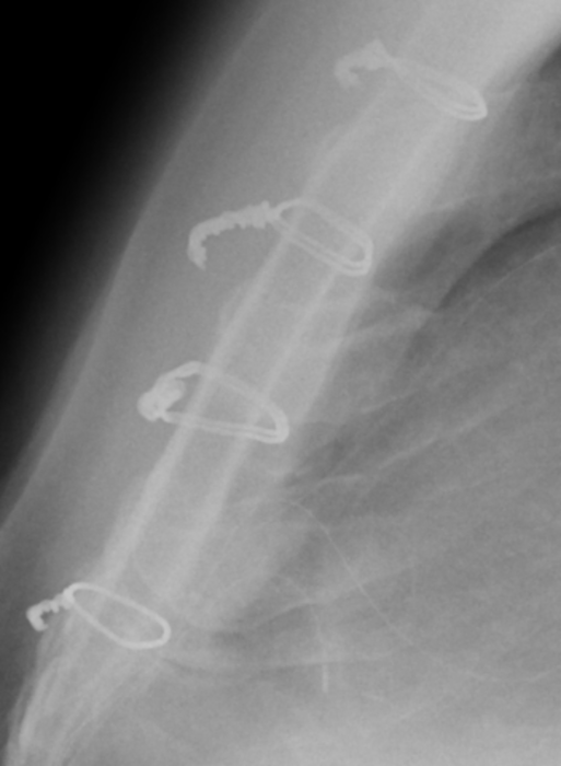 April 4, 2024 - Enlarged photo of side-view X-ray shows clearly the median sternotomy wires. April 4, 2024 - Enlarged photo of side-view X-ray shows clearly the median sternotomy wires.