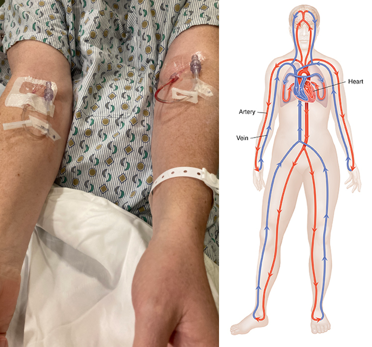 My arms before cardiac catheterization, and a circulatory system diagram. An additional entry point was later added to my right wrist.