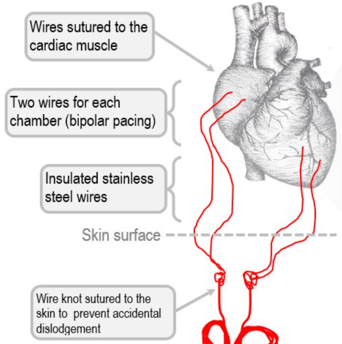 Temporary Pacemaker Wires